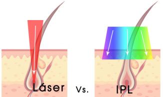 lc3a1ser-vs-ipl