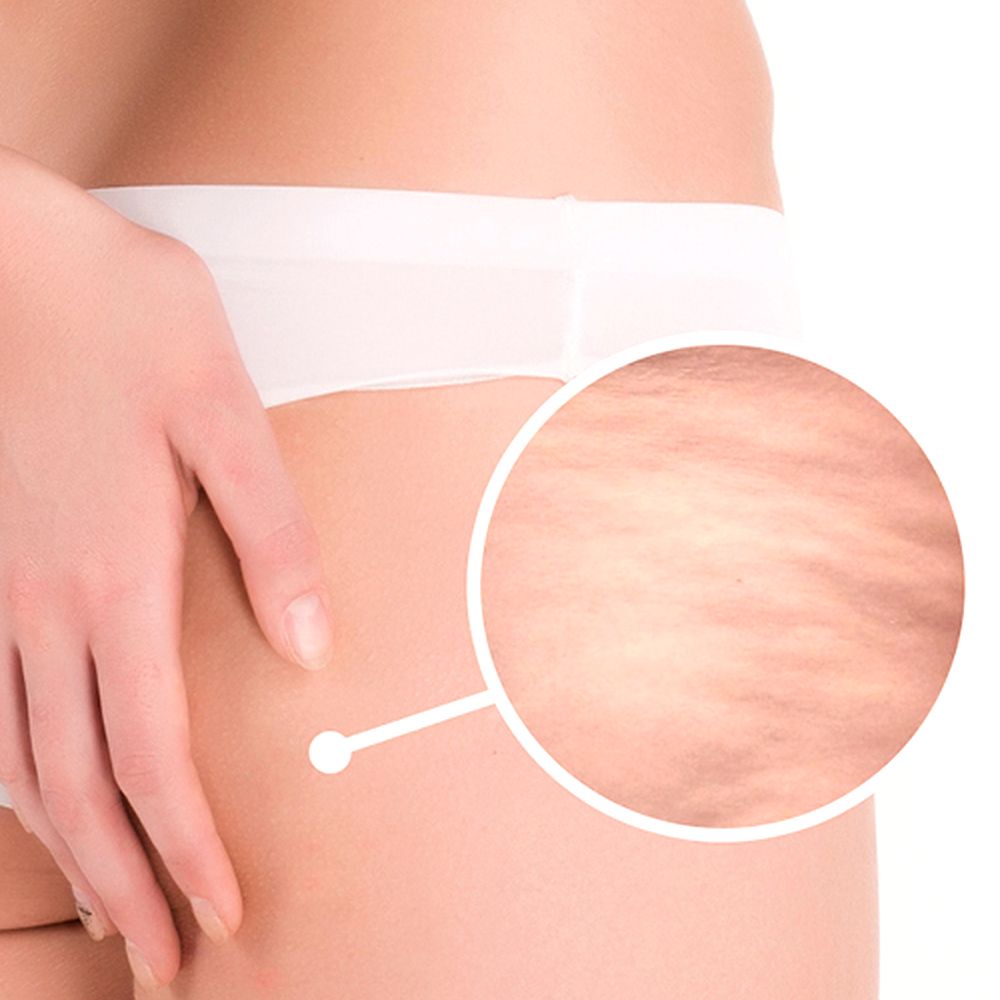VelaShape™, el tratamiento definitivo contra la celulitis